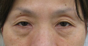 目の下のたるみ、目のくまでお悩みの方、切らずに完璧に解決します。TCB-R法　手術直後　症例写真